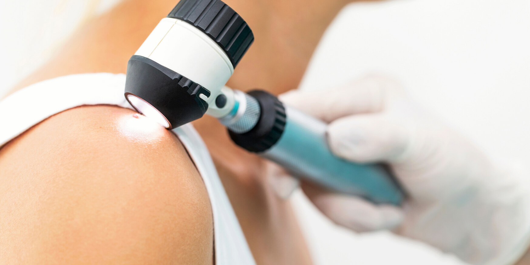 Trenutno pregledavate Madeži, sunce i melanom: kako prepoznati rizične promjene na koži